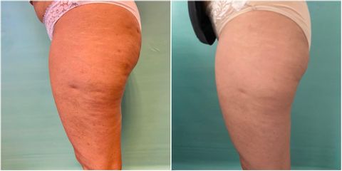 Cellulite - Dott.ssa Rosaria D'Ambrosio