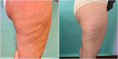 Cellulite - Dott.ssa Rosaria D'Ambrosio