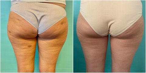 Cellulite - Dott.ssa Rosaria D'Ambrosio