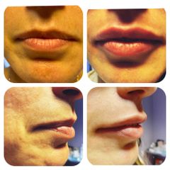 Filler labbra - RD’A Medicina Estetica Dietologica - Dott.ssa Rosaria D'Ambrosio
