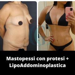 Lipoaddominoplastica - Dott. Gianluca Clemente