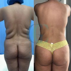 Liposuzione - Dott. Gianluca Clemente