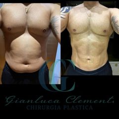 Liposuzione - Dott. Gianluca Clemente
