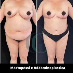 Addominoplastica - Dott. Gianluca Clemente