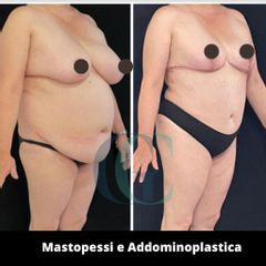 Addominoplastica - Dott. Gianluca Clemente