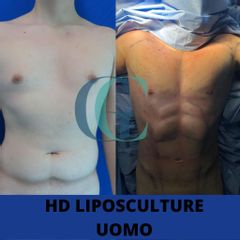 Liposuzione - Dott. Gianluca Clemente