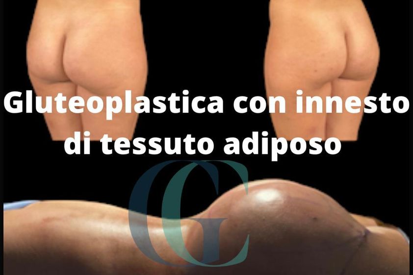 Gluteoplastica prima e dopo - 844860