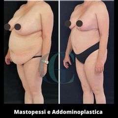 Mastopessi - Dott. Gianluca Clemente