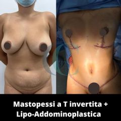 Mastopessi - Dott. Gianluca Clemente