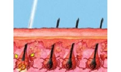 Dermalflash