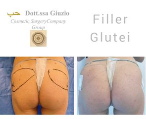Filler Glutei - Dott.ssa Federica Giuzio