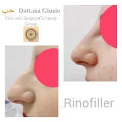 Rinofiller - Dott.ssa Federica Giuzio