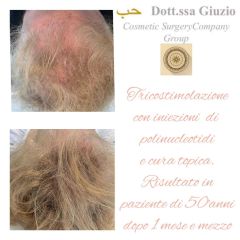 Trapianto capelli - Dott.ssa Federica Giuzio