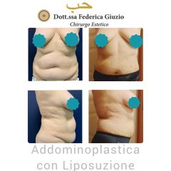 Addominoplastica - Dott.ssa Federica Giuzio