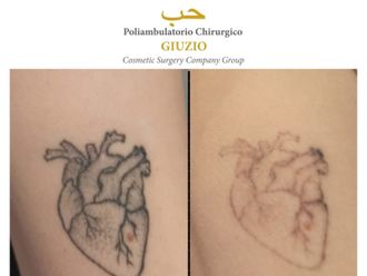 Rimozione tatuaggi prima e dopo - 871747