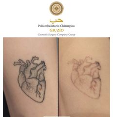 Rimozione tatuaggi - Dott.ssa Federica Giuzio