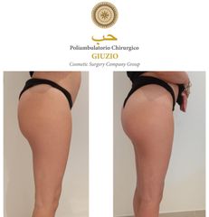 Liposuzione - Dott.ssa Federica Giuzio