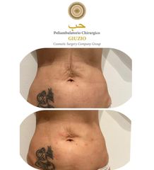 Endolift - Dott.ssa Federica Giuzio