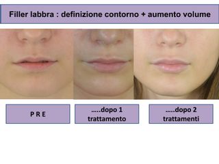 Filler labbra - Studi Medici Ama: Dott.ssa Lucia Costucci