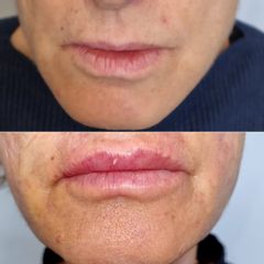 Dott.ssa Lucia Lyanna Costucci Trattamento filler a base di acido ialuronico