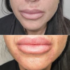 Dott.ssa Lucia Lyanna Costucci armonizzazione labbra con acido ialuronico