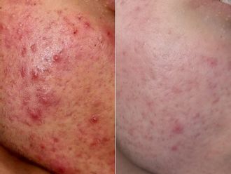 Peeling chimico prima e dopo - 879097