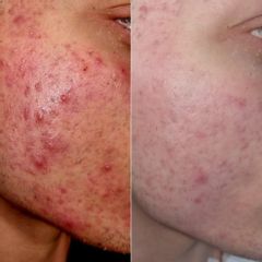 Dott.ssa Lucia Lyanna Costucci Acne e cicatrici: prima e dopo con protocollo combinato (peeling, col