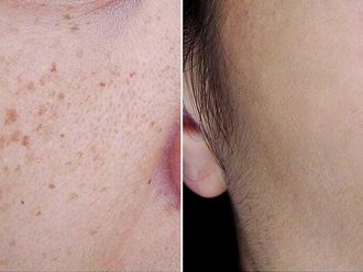 Peeling chimico prima e dopo - 879592