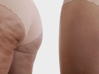 Cellulite prima e dopo - 879593