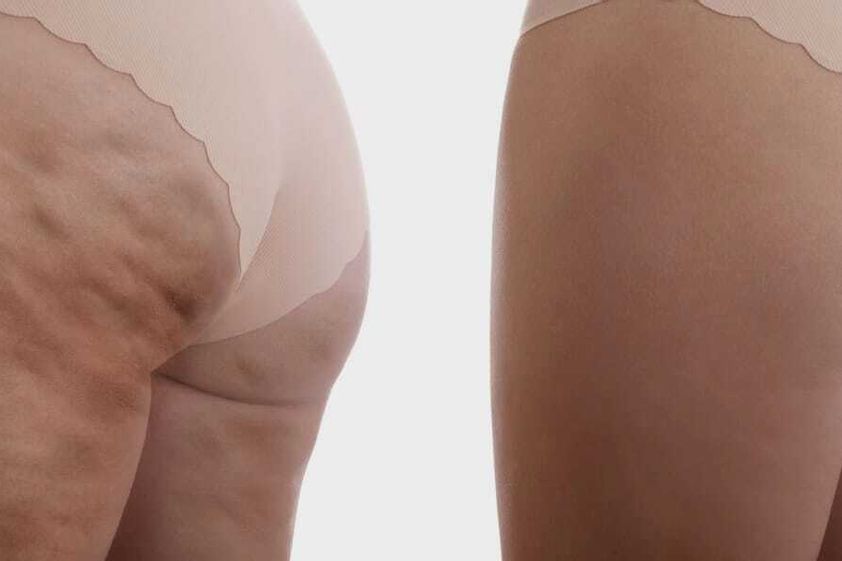 Cellulite prima e dopo - 879593