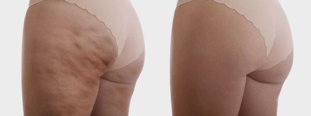 Dott.ssa Lucia Lyanna Costucci cellulite donna coulotte e coscia