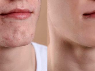 Peeling chimico prima e dopo - 879619