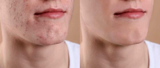 Dott.ssa Lucia Lyanna Costucci acne uomo pre e post