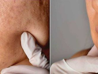 Peeling chimico prima e dopo - 879621