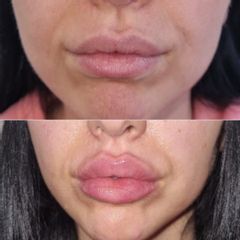 Dott.ssa Lucia Lyanna Costucci Filler labbra molto costruite