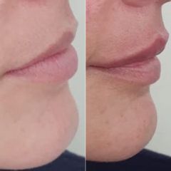 Dott.ssa Lucia Lyanna Costucci Filler labbra