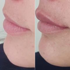 Dott.ssa Lucia Lyanna Costucci Filler labbra profilo senza volume