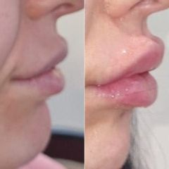 Dott.ssa Lucia Lyanna Costucci labbra volume prima e dopo