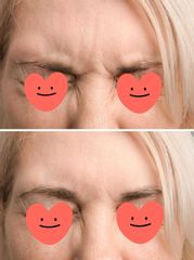 Dott.ssa Lucia Lyanna Costucci trattamento botox fronte prima e dopo