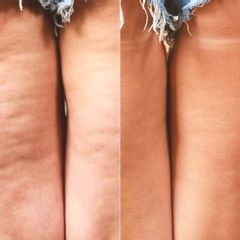 Dott.ssa Lucia Lyanna Costucci trattamento cellulite