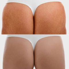 Dott.ssa Lucia Lyanna Costucci trattamento glutei