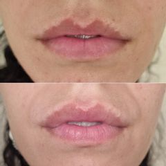 Dott.ssa Lucia Lyanna Costucci labbra trattate con filler
