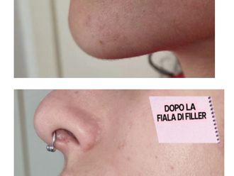 Filler labbra prima e dopo - 880230