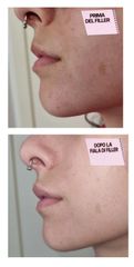 Dott.ssa Lucia Lyanna Costucci filler labbra prima e dopo