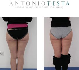 Liposcultura - Dr. Antonio Testa