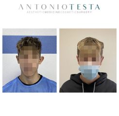 Otoplastica - Dr. Antonio Testa