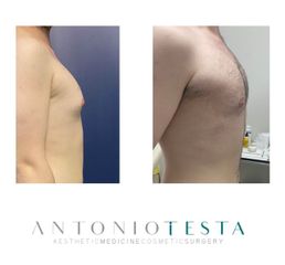 Ginecomastia - Dr. Antonio Testa
