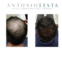 Trattamento per la caduta dei capelli (PRP) - Dr. Antonio Testa