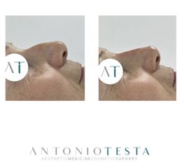 Rinofiller - Dr. Antonio Testa