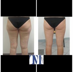 Liposuzione - Dr.ssa Truccolo Marialisa